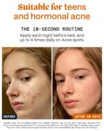 Norse Organics Pimple Stopper Night Balm | Acne Spot Treatment for Redness and Soothing Skin | Natural Bioactive Ingredients Help Treat Blemishes and Breakouts | Dermatologist Approved Skincare | 1 oz - Image 5