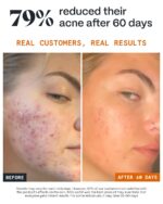 Norse Organics | The Complete System for Pimples 2.0 | 4 Step Skincare Kit with Natural Arctic Herbs | Includes Pimple Stopper Day & Night Balms, Scar Balm, Face Scrub | For All Skin Types (4 pcs) - Image 4